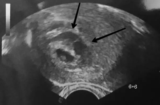 hämatom schwangerschaft abbluten - Bedeutet braunes Blut, dass ein subchoriales Hämatom heilt