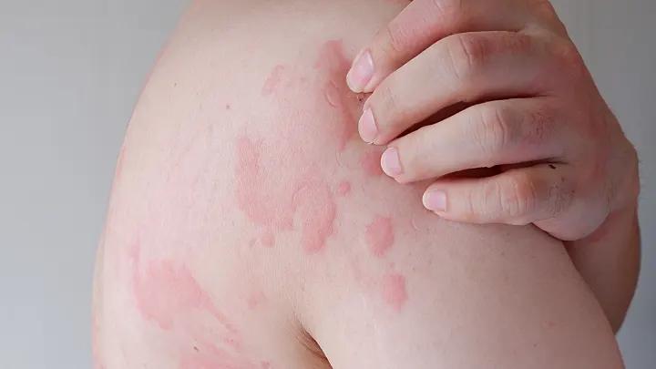 jucken am ganzen körper mit ausschlag - Bei welcher Krankheit juckender Ausschlag