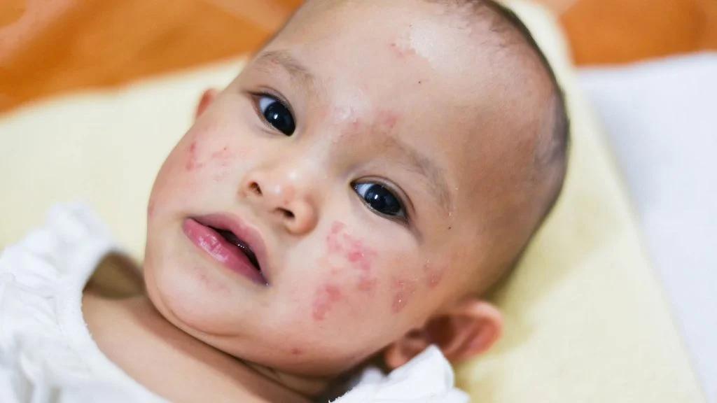 glutenunverträglichkeit baby - Entwickeln sich Glutenallergien bei Babys