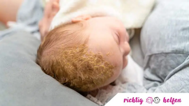 bekommt jedes baby milchschorf - Hat jedes Baby Milchschorf