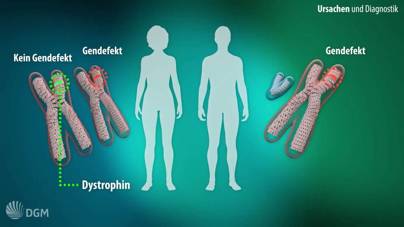 muskelatrophie ursachen - Hat man bei Muskelatrophie Schmerzen