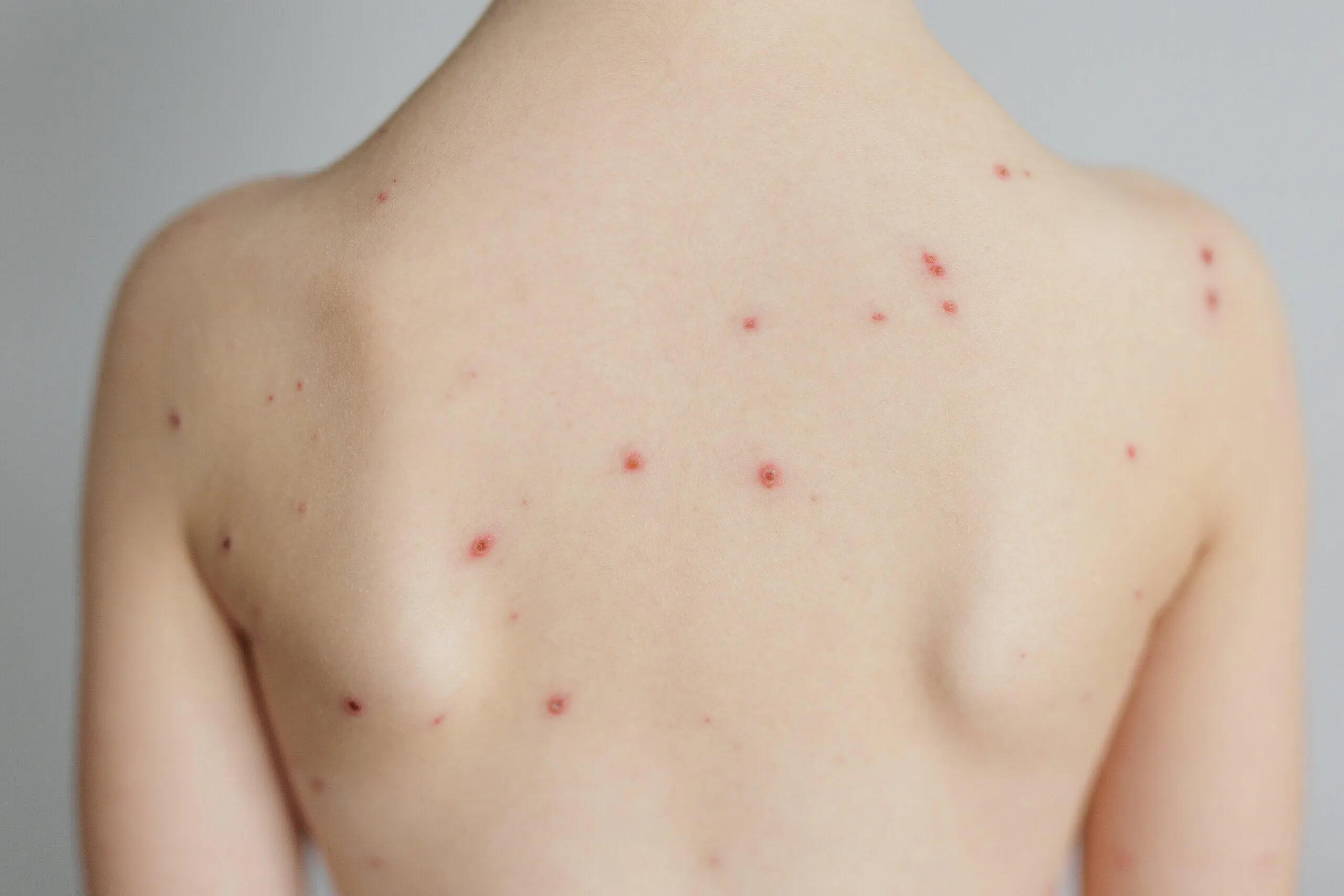 Windpocken bei Kindern: Symptome, Ansteckung und Vorbeugung - In welchem Alter sind Windpocken gefährlich windpocken kinder symptome - In welchem Alter sind Windpocken gefährlich