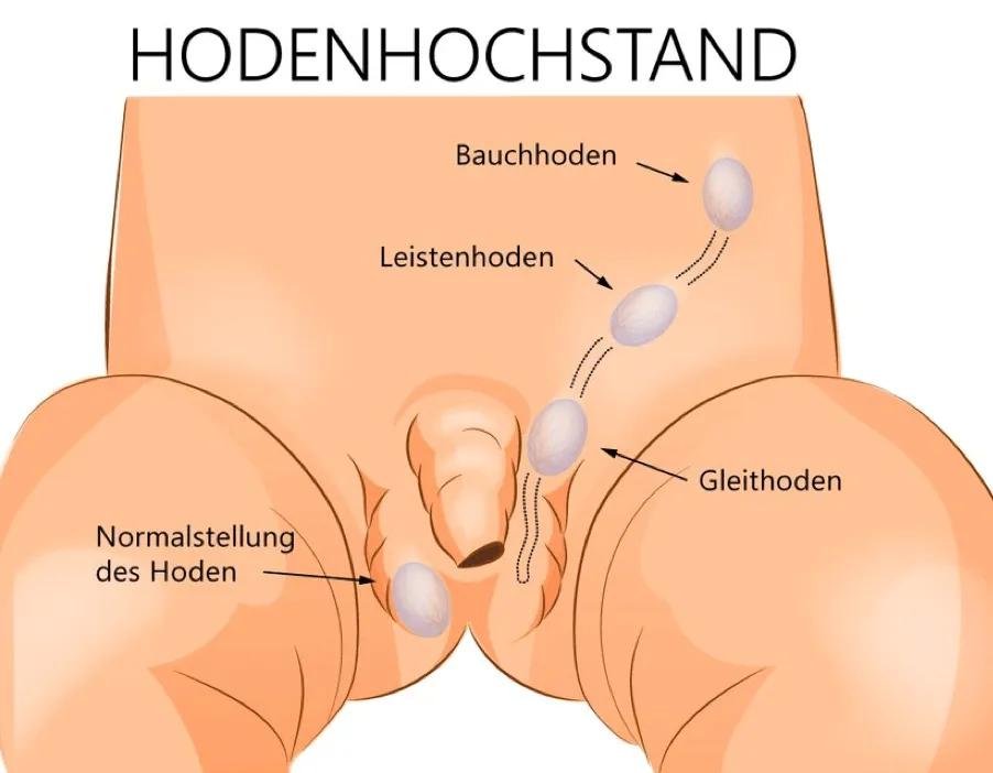 hodenhochstand baby - In welchem Alter wird ein Hodenhochstand operiert
