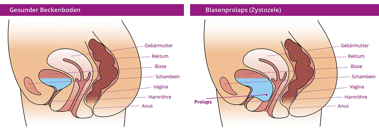 blase entleeren nach geburt - In welcher Position entleert sich die Blase am besten