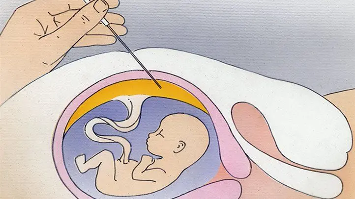 down syndrom test schwangerschaft - In welcher Schwangerschaftswoche wird der Down-Syndrom Test gemacht