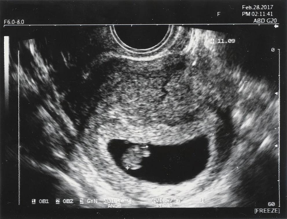 missed abort anzeichen - In welcher Woche am häufigsten Missed Abortion