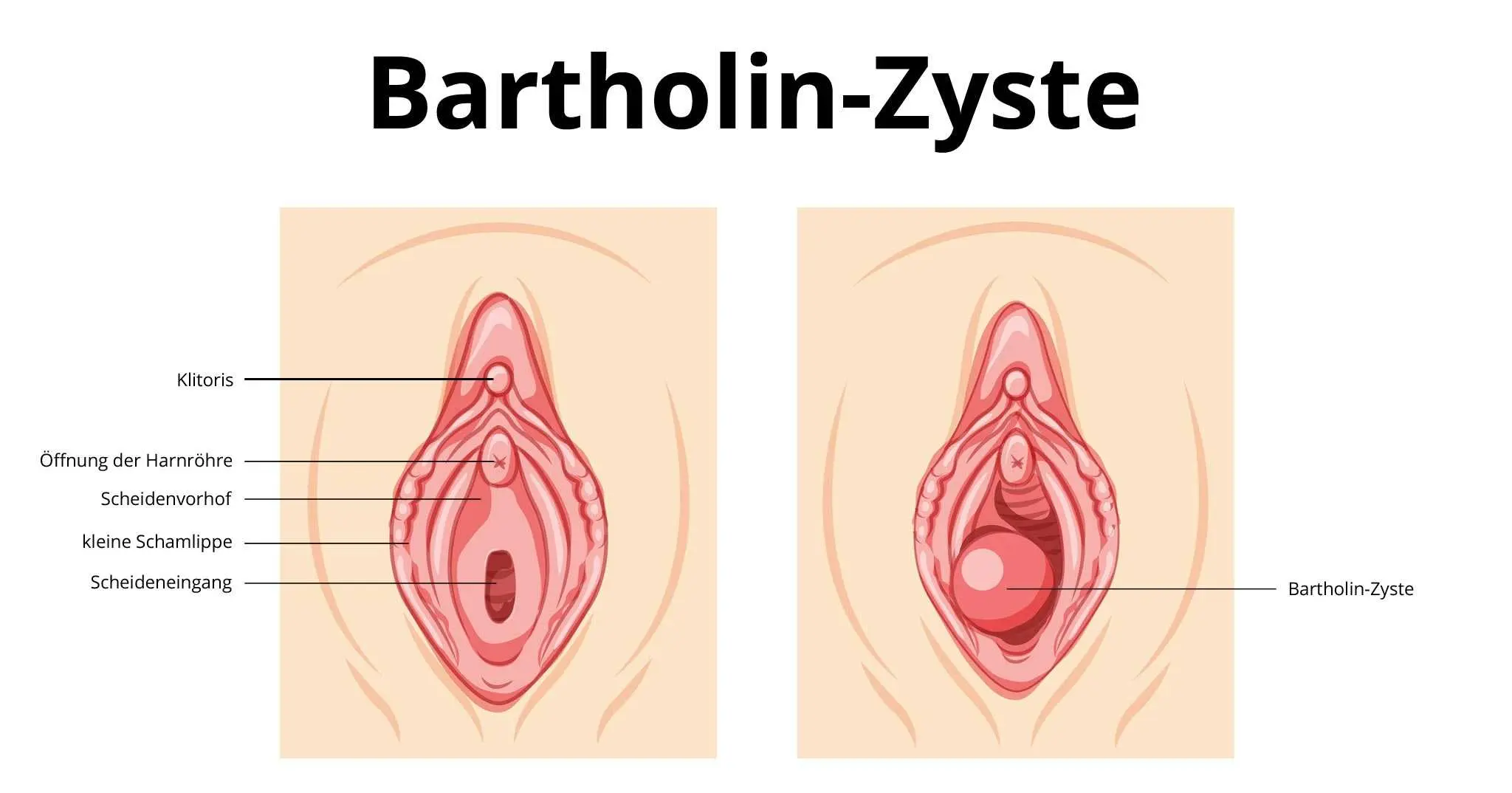 Bartholinitis in der Schwangerschaft: Was Sie wissen müssen - Ist Bartholinitis ein Notfall bartholinitis schwangerschaft - Ist Bartholinitis ein Notfall