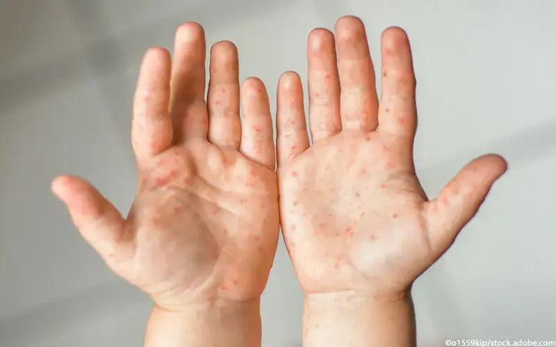 coxsackie virus schwangerschaft - Ist das Coxsackie Virus ansteckend