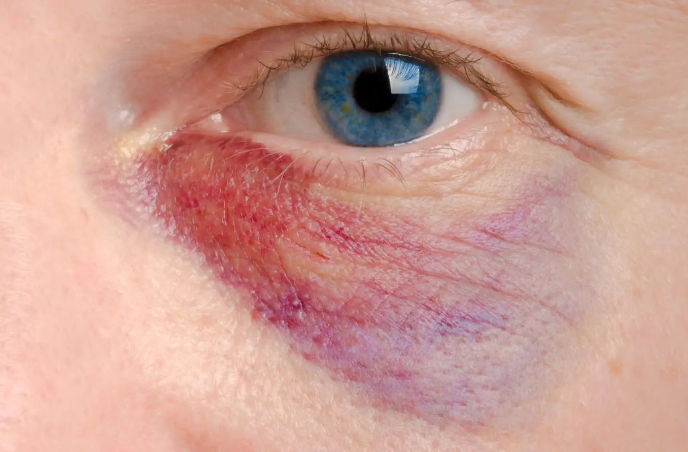 Blaues Auge Nach Sturz Auf Den Kopf