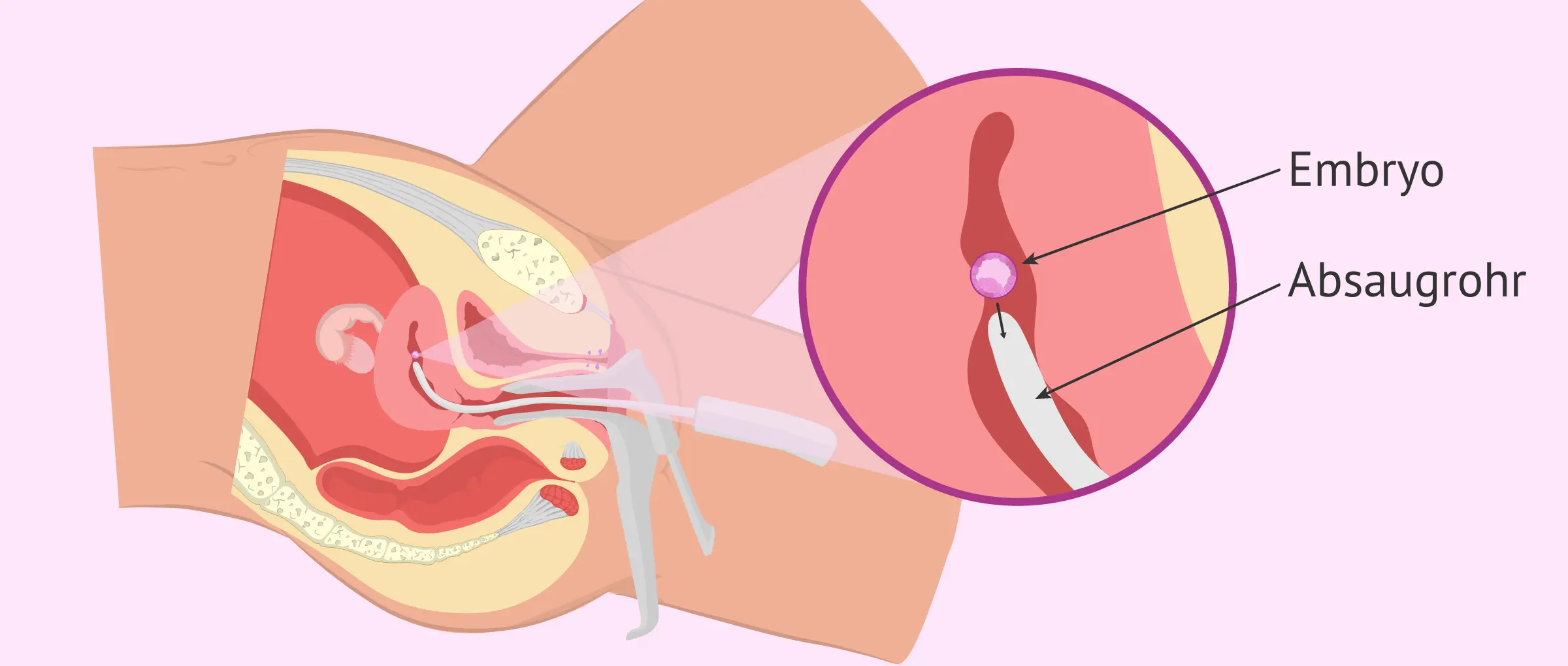 absaugung schwangerschaft kosten - Ist eine Absaugung schmerzhaft