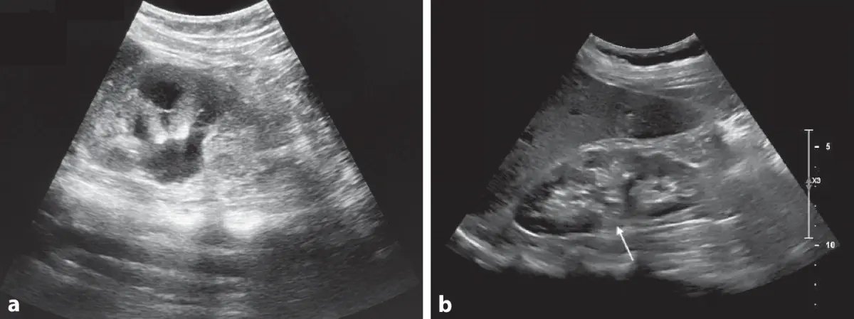 hydronephrose schwangerschaft - Ist eine Hydronephrose gefährlich