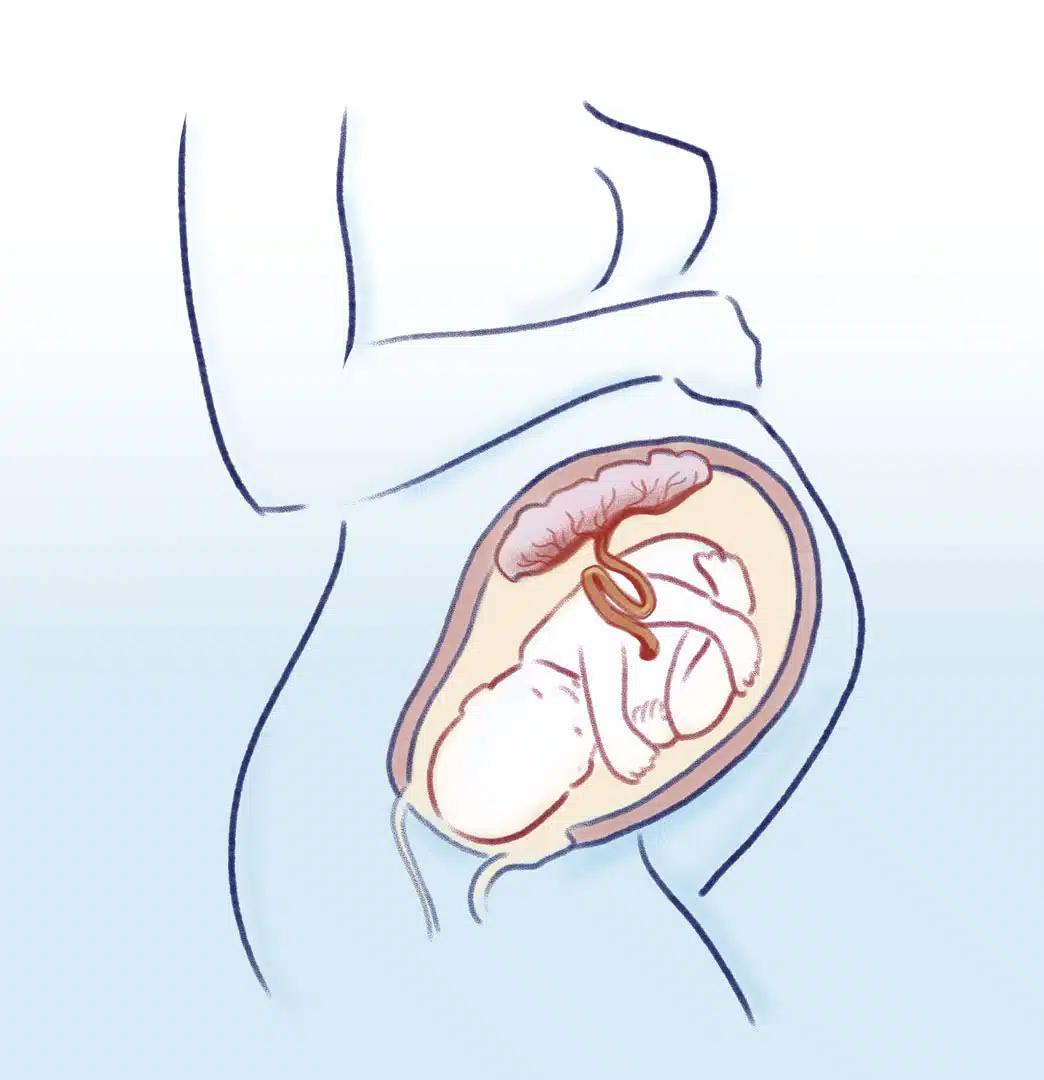 leichte schilddrüsenüberfunktion schwangerschaft - Ist eine leichte Schilddrüsenüberfunktion gefährlich
