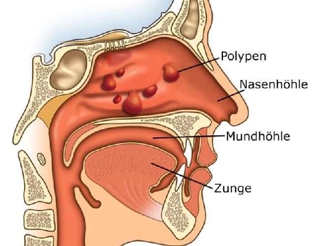 polypen op nase - Ist eine Nasenpolypen OP gefährlich