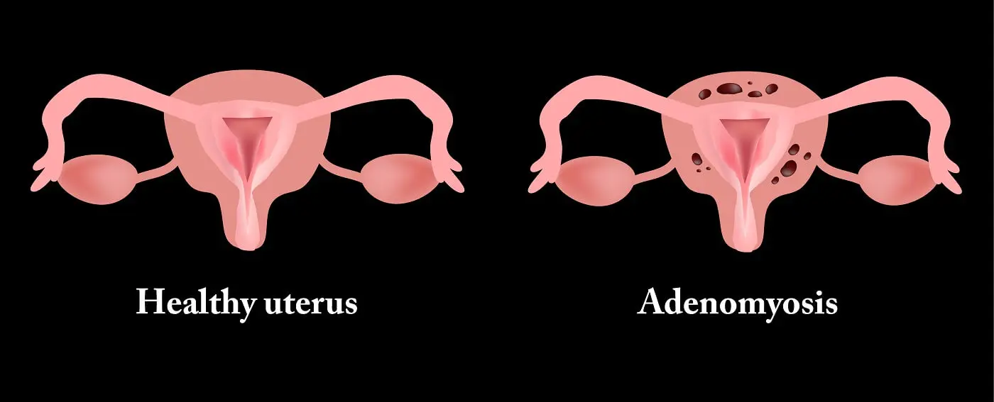 adenomyose schwangerschaft gefährlich - Ist eine Schwangerschaft bei Endometriose eine risikoschwangerschaft
