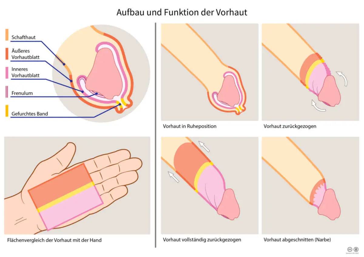 vorhaut entzündet kind wann zum arzt - Ist eine Vorhaut Entzündung schlimm