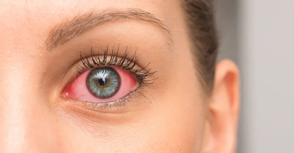 kind rotes auge - Ist es schlimm wenn das Auge rot ist