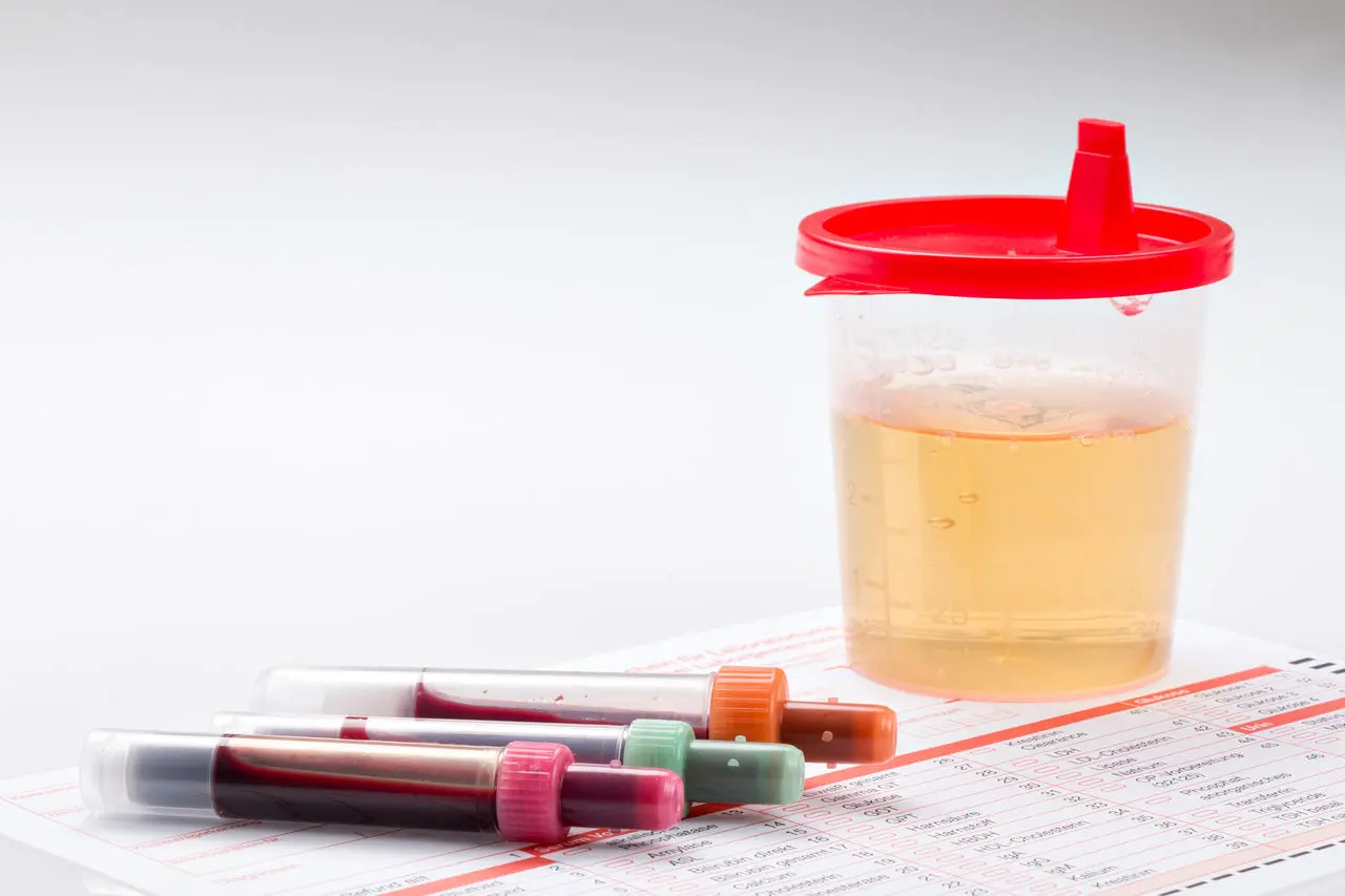 eiweiß im urin schwangerschaft - Ist es schlimm wenn man Eiweiß im Urin hat