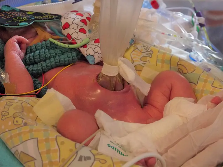 gastroschisis lebenserwartung - Ist Gastroschisis vererbbar