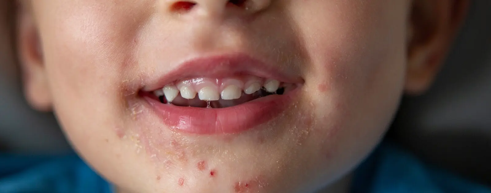 hand mund fuß krankheit schwangerschaft - Ist Hand-Mund-Fuß gefährlich für Schwangere