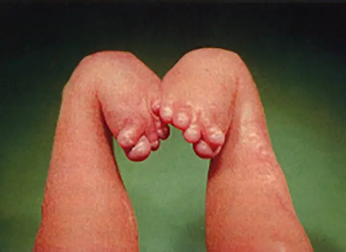 kokain in der schwangerschaft - Ist Kokain Plazentagängig