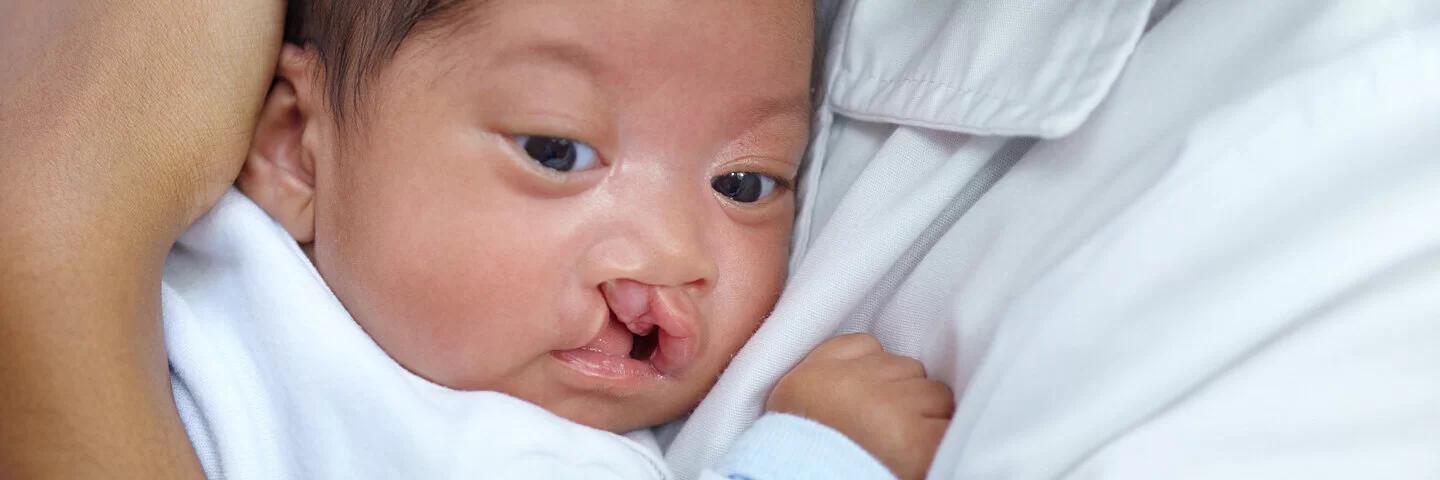 lippen kiefer gaumenspalte ursache - Ist Lippen-Kiefer-Gaumenspalte vererbbar