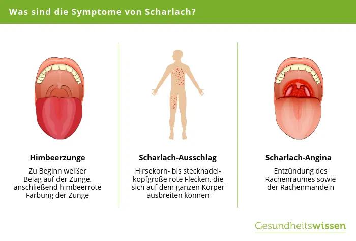 scharlach infektionswege - Ist Scharlach Tröpfcheninfektion