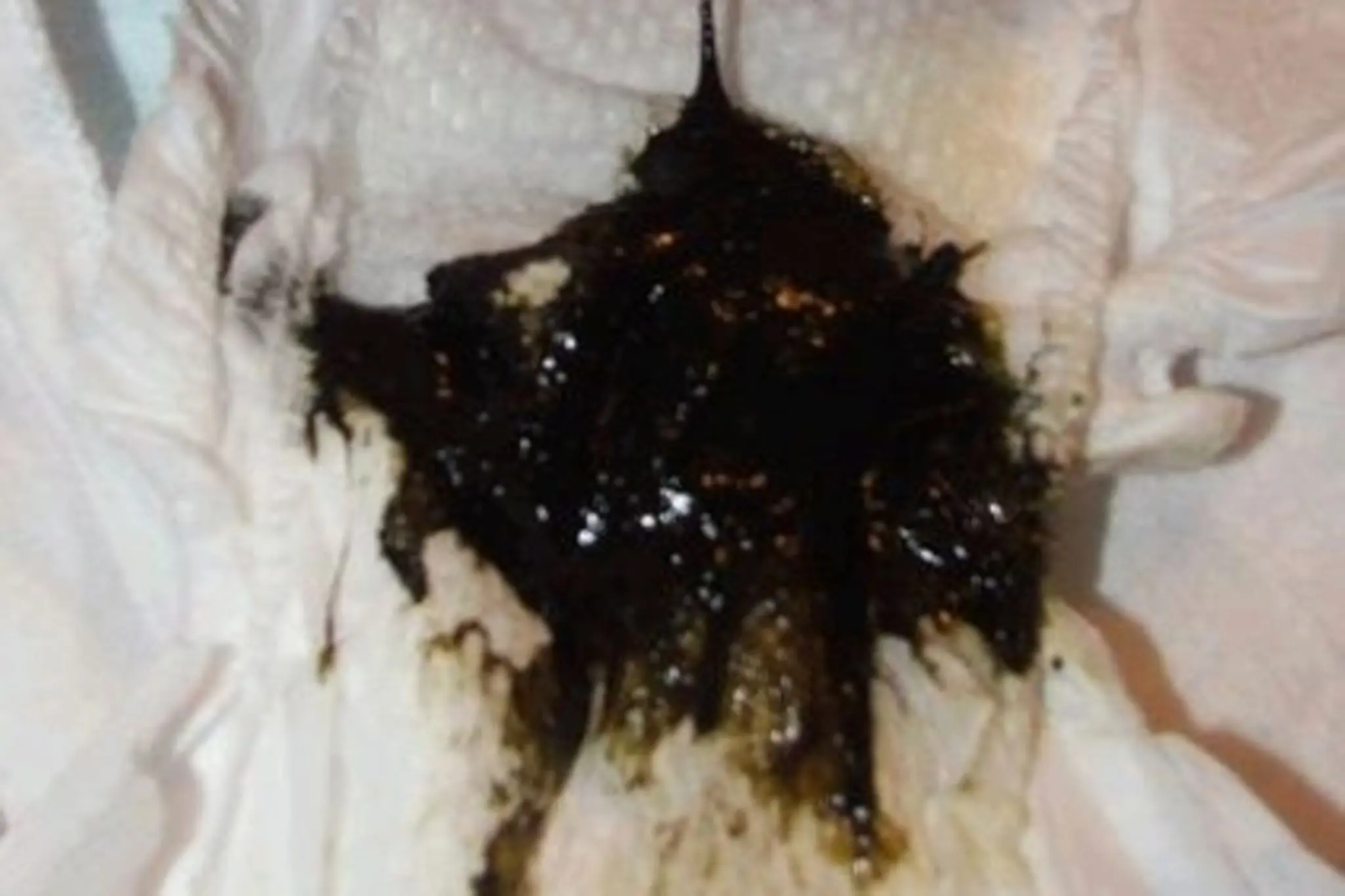 Schwarzer Durchfall in der Schwangerschaft: Ursachen, Symptome und Behandlung - Ist schwarzer Stuhlgang ein Notfall schwarzer durchfall schwangerschaft - Ist schwarzer Stuhlgang ein Notfall