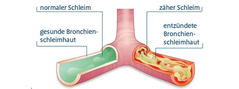 husten spastisch - Ist spastischer Husten ansteckend