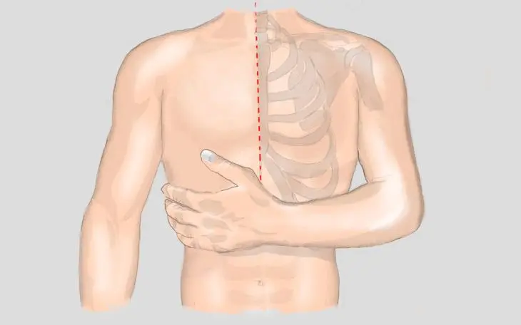 rippenfellentzündung schwangerschaft - Ist Wärme bei einer Rippenfellentzündung gut