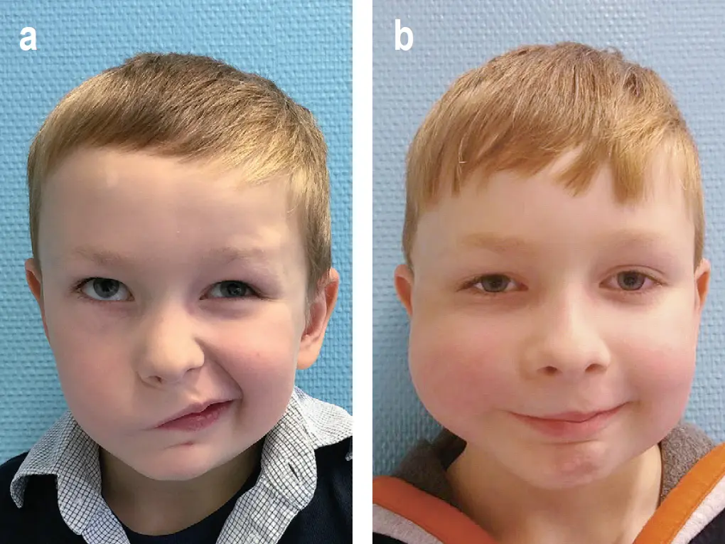 Fazialisparese während der Schwangerschaft: Erfahrungen und Informationen - Ist Wärme gut bei Gesichtslähmung fazialisparese schwangerschaft erfahrungen - Ist Wärme gut bei Gesichtslähmung