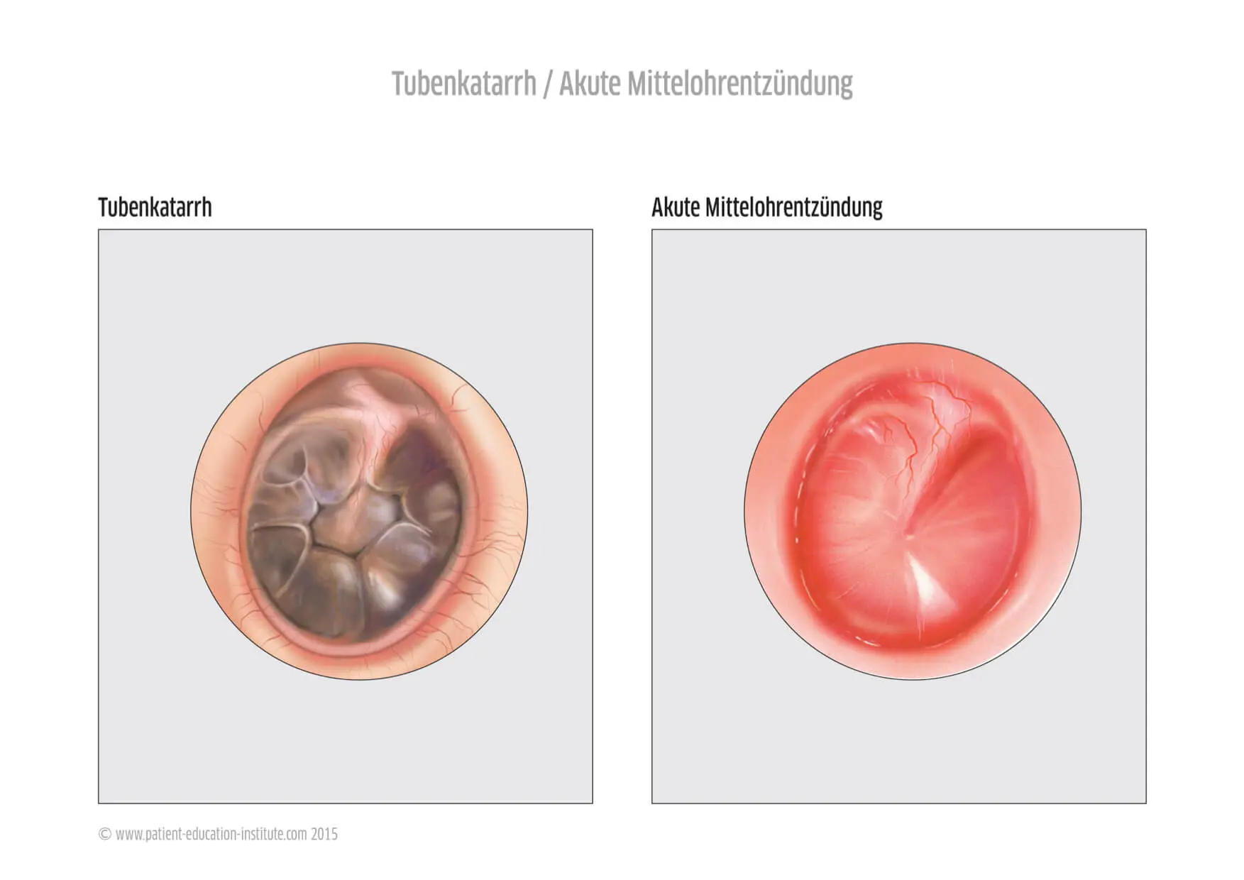 mittelohrentzündung blut - Kann bei einer Mittelohrentzündung das Ohr bluten