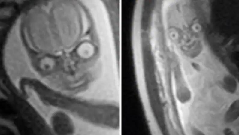 mrt in der schwangerschaft gefährlich - Kann beim MRT was passieren