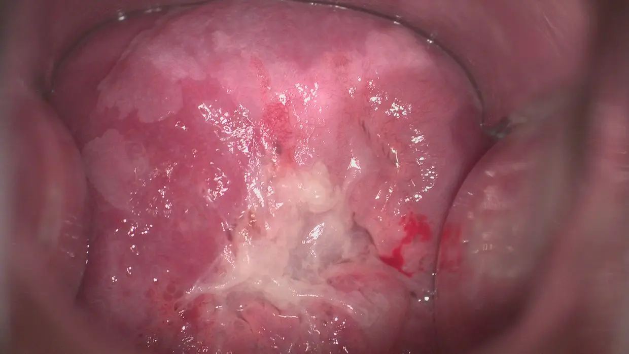 gebärmutterhalskrebs in der schwangerschaft festgestellt - Kann der Frauenarzt Gebärmutterhalskrebs erkennen