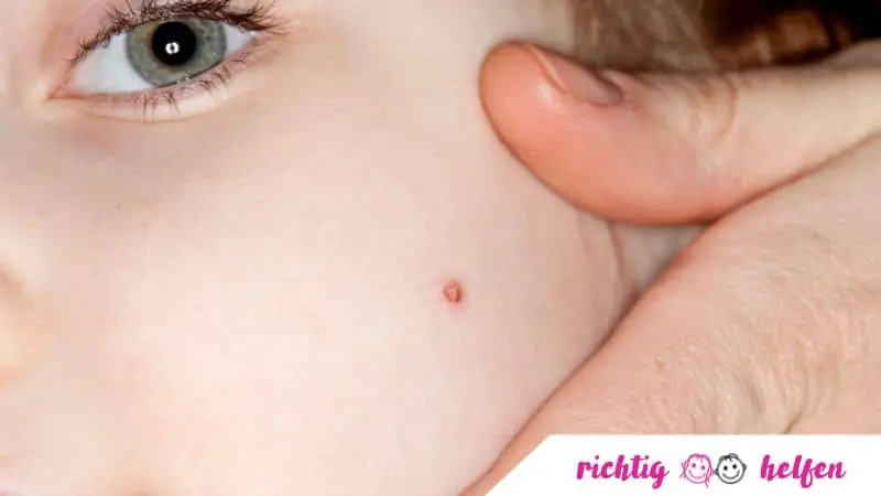 Warzen bei Babys: Ursachen, Behandlung und Vorbeugung - Kann der Kinderarzt Warzen entfernen warzen bei babys - Kann der Kinderarzt Warzen entfernen