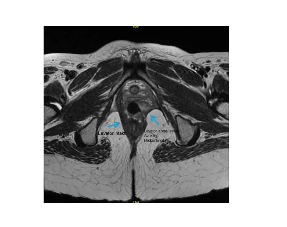 schließmuskel nach geburt - Kann der Schließmuskel wieder zusammenwachsen