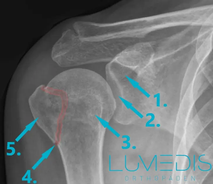 knochenbruch ohne schmerzen - Kann ein Bruch nicht Schmerzen