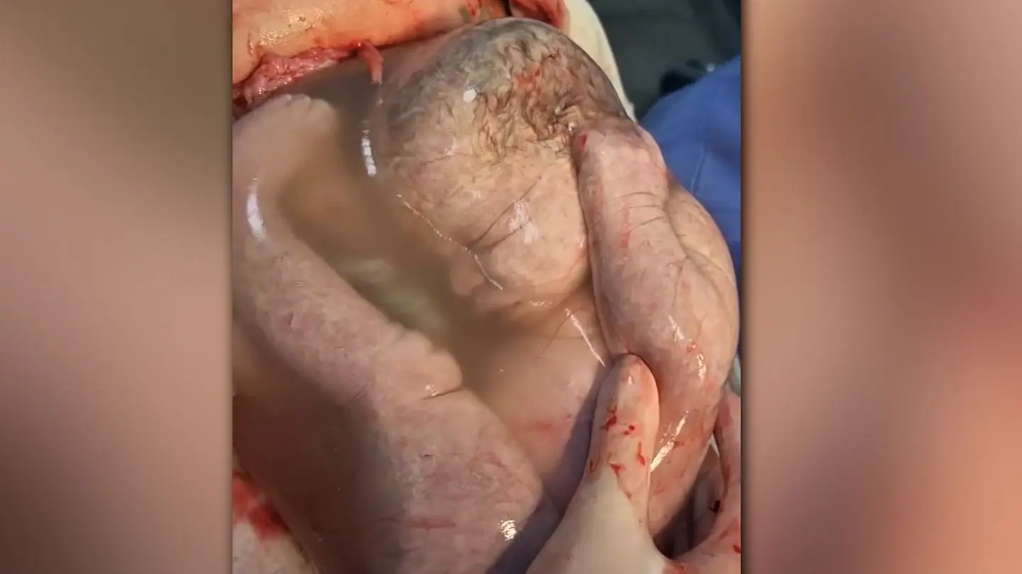 glückshaube geburt - Kann ein Kind in der Fruchtblase zur Welt kommen