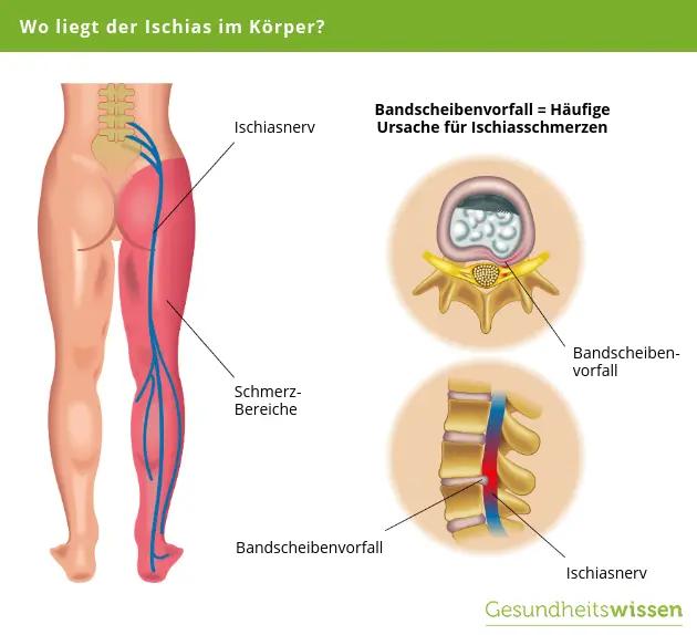 ischias chiropraktiker - Kann ein Osteopath bei Ischias helfen