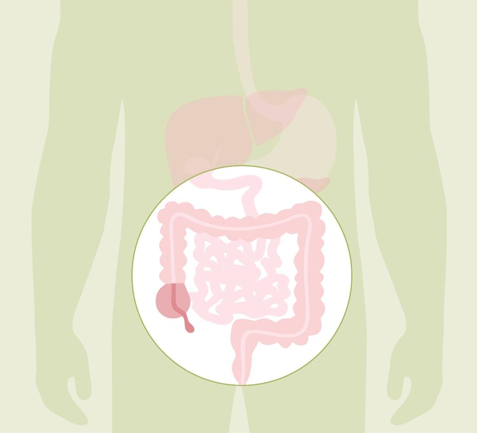 blinddarm nach geburt - Kann eine Blinddarmentzündung plötzlich auftreten