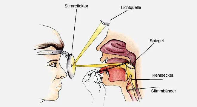 kehlkopfentzündung schwangerschaft gefährlich - Kann eine Kehlkopfentzündung gefährlich werden