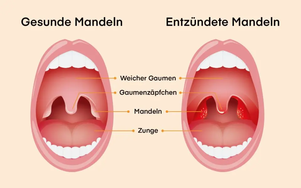 was hilft bei mandelentzündung kinder - Kann eine Mandelentzündung von alleine weg gehen