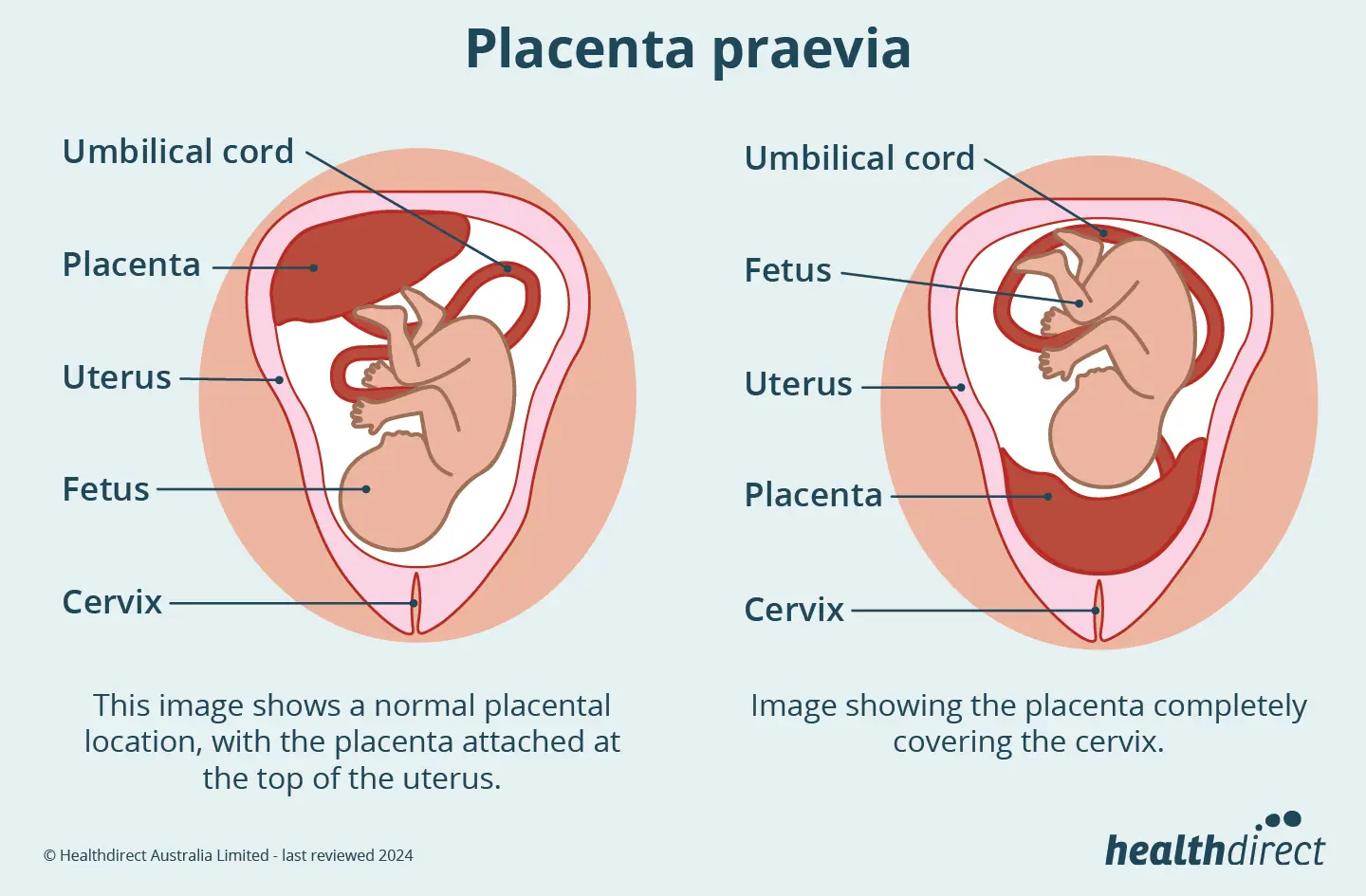 Plazenta praevia: Was Sie wissen müssen - Kann eine Plazenta praevia verschwinden placenta praevia - Kann eine Plazenta praevia verschwinden