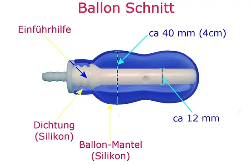 epino geburt - Kann Epi-No Wehen auslösen