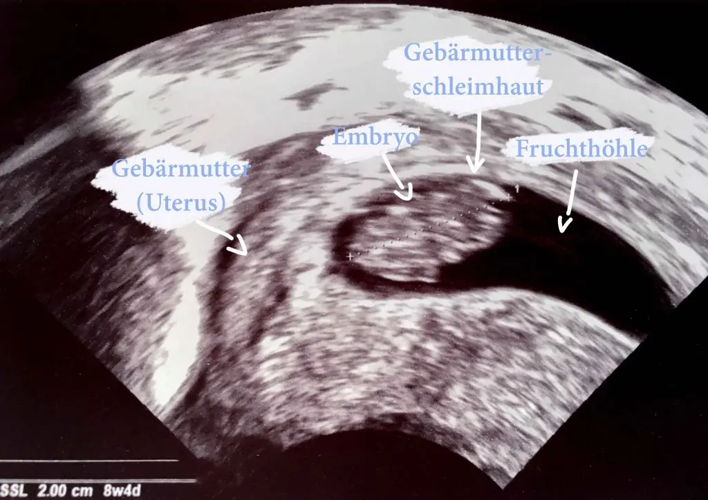 ultraschall gebärmutterschleimhaut schwangerschaft - Kann Frauenarzt Einnistung im Ultraschall sehen