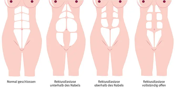 rektusdiastase wann geschlossen nach geburt - Kann geschlossene Rektusdiastase wieder aufgehen