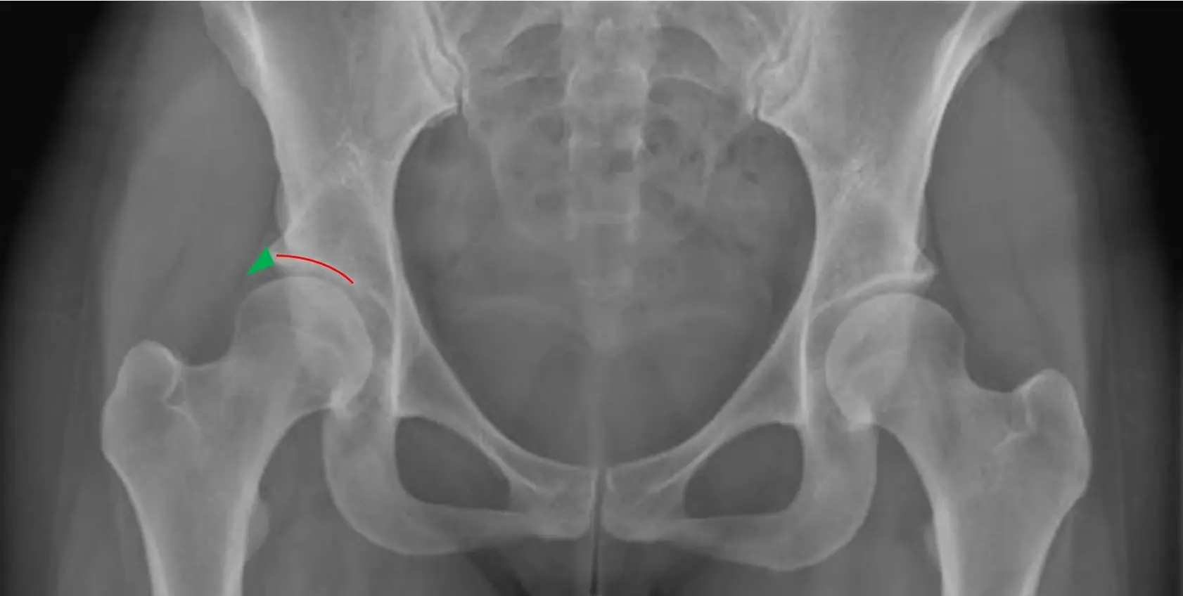 was tun bei hüftdysplasie - Kann Hüftdysplasie geheilt werden