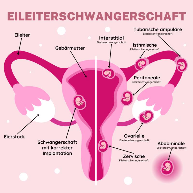 wie fühlt sich eileiterschwangerschaft an - Kann ich eine Eileiterschwangerschaft ertasten
