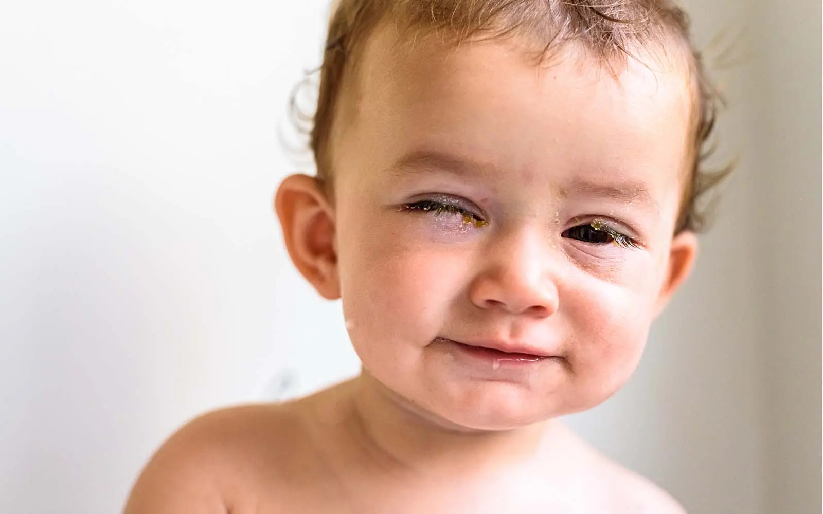 bindehautentzündung kinder ansteckend - Kann Kind mit Bindehautentzündung in KiTa