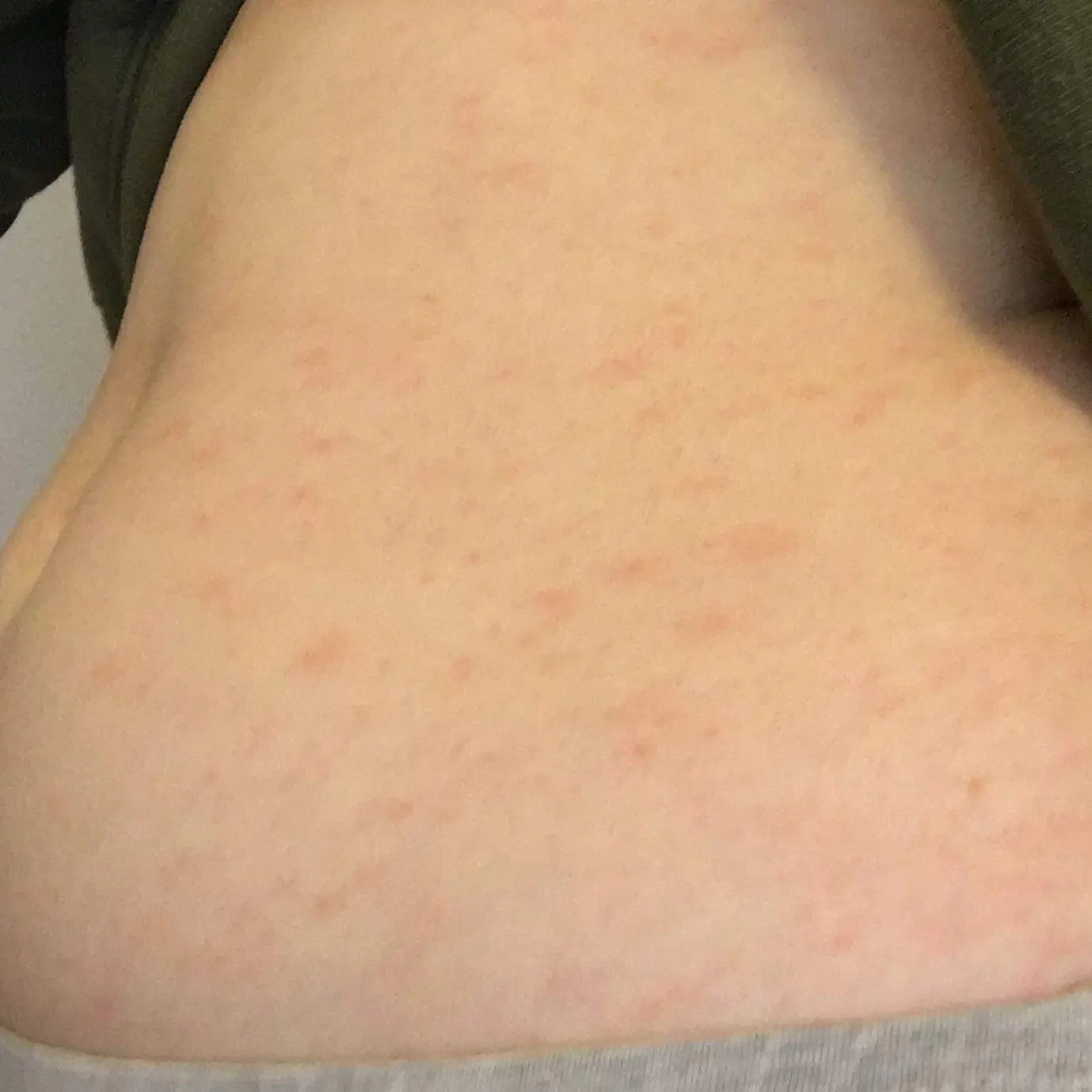 kleine rote punkte am bauch - Kann Krätze am Bauch anfangen