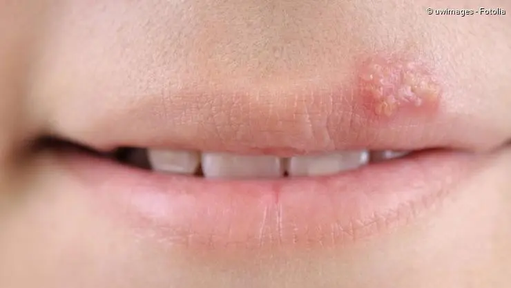 ist herpes in der schwangerschaft gefährlich - Kann Lippenherpes zu Fehlgeburt führen